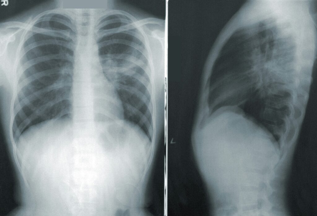 Digital X-Rays